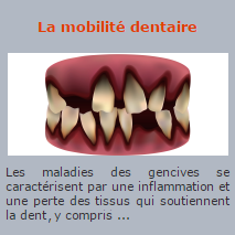 La mobilité dentaire