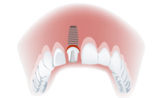 Implant couronne
